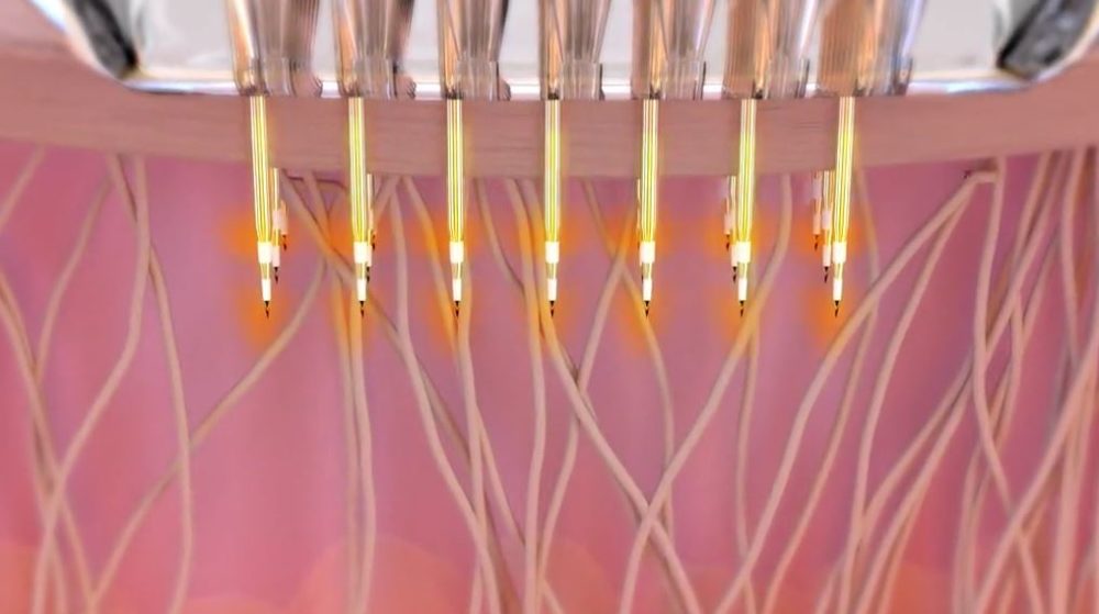 How Does Potenza RF Microneedling Works