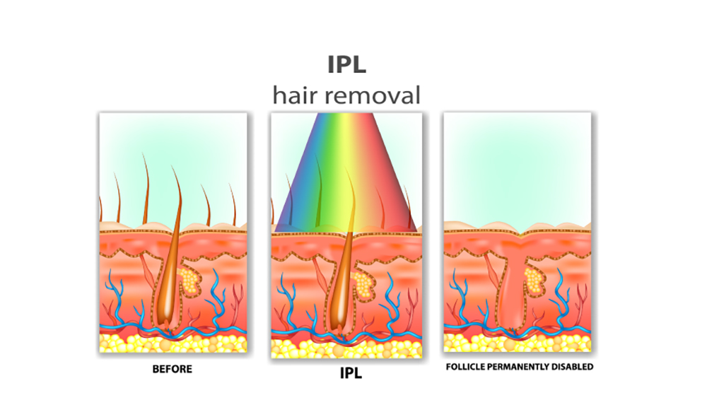 IPL Hair Removal Singapore Halley Medical Aesthetics How it works