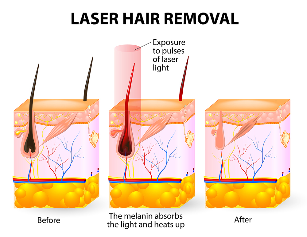Laser Hair Removal Singapore Halley Medical Aesthetics How it works