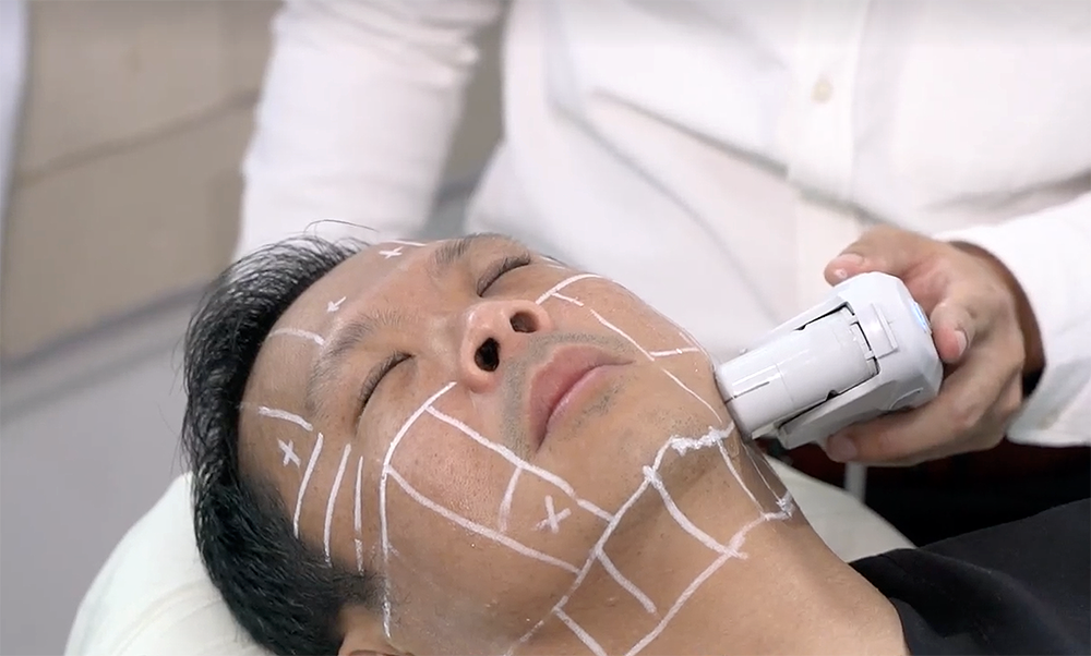 Dr. Terence Tan Ultherapy treatment Singapore FAQ