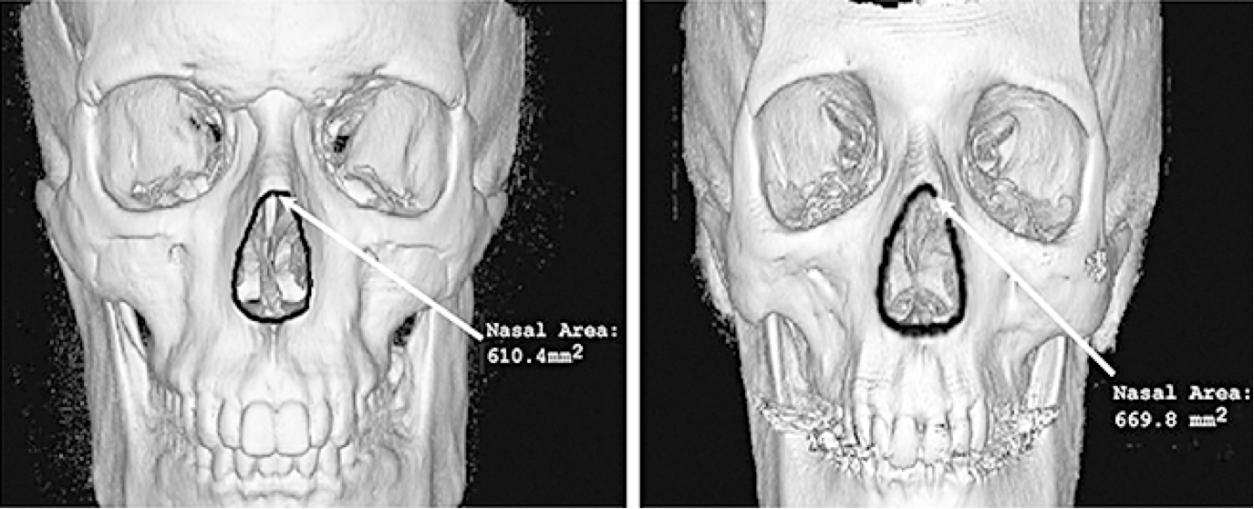 Dermal Filler Bone-resorption_Skull
