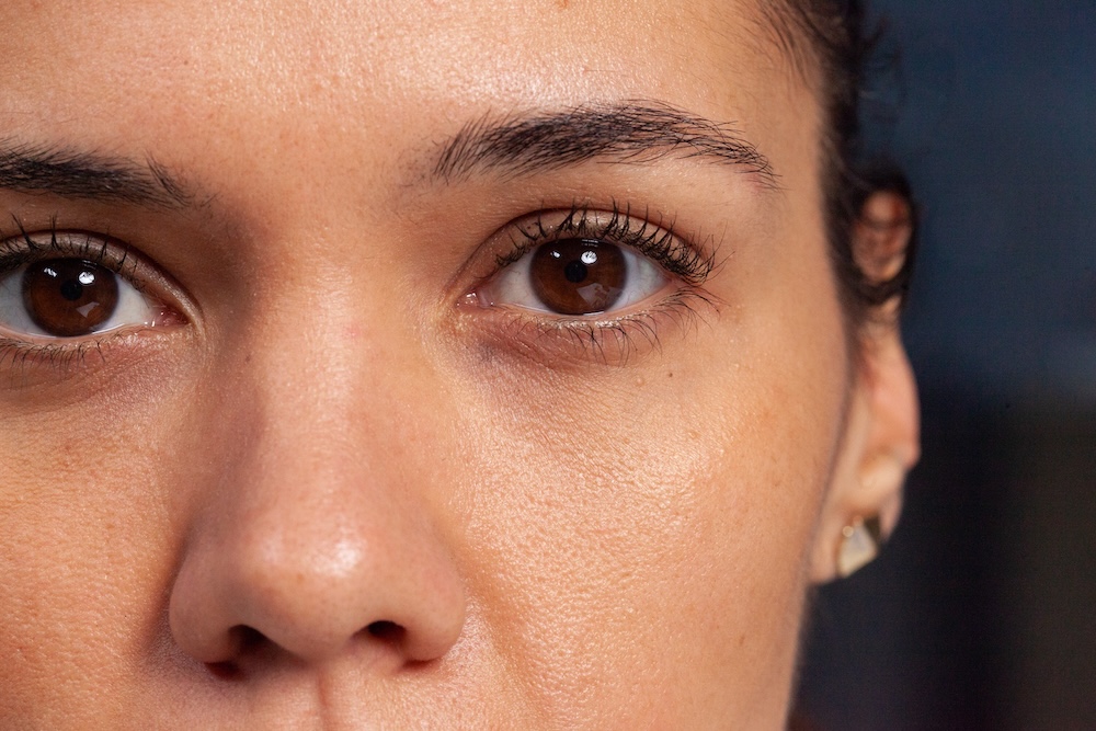 Dark Eye Circles Treatment Singapore 