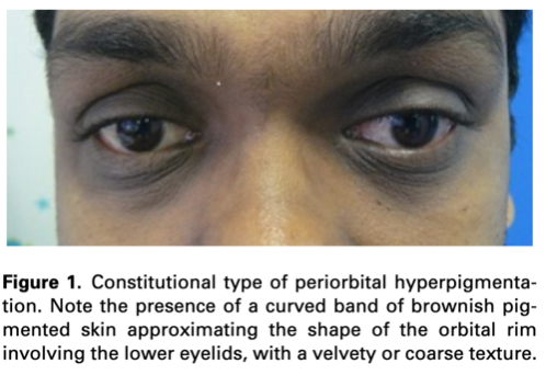 Dark Eye Circles Removal Treatments Singapore