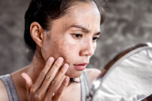 Melasma Treatment Singapore Halley Medical Aesthetics